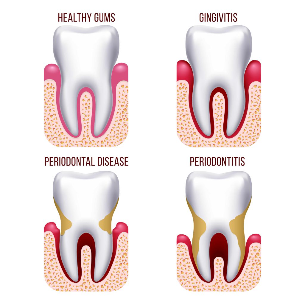 el-embarazo-y-su-relaci-n-con-la-enfermedad-periodontal-world-s-hygienist