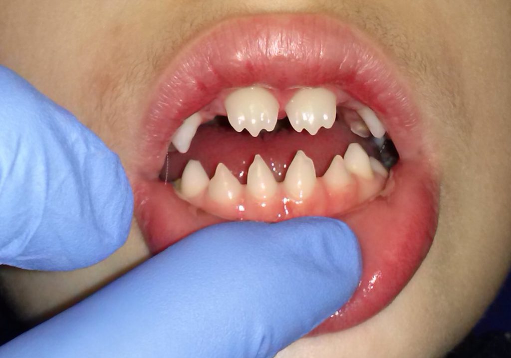 DIENTES DE HUTCHINSON Y EL HIGIENISTA DENTAL World's Hygienist