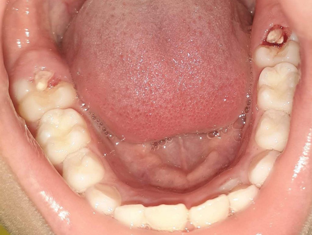 SECUESTRO OSEO ERUPTIVO World's Hygienist